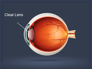 Cataract surgery and cataract screening Downey, Cerritos and Los Angeles CA./>