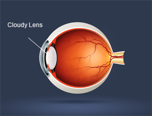 Restor, Crystalens, Lensx and Toric IOL for Downey and Los Angeles CA.